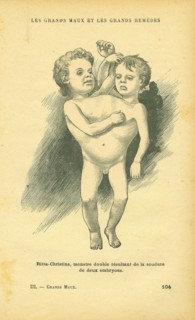 Siamese or conjoined twins