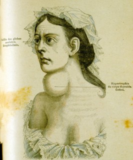 Woman with goitre