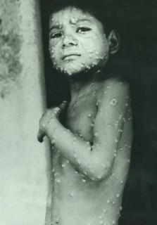 Last indigenous case of Smallpox in India, Katihar District, Eihar State