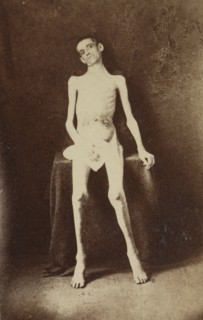 Returned Federal prisoner from Andersonville prison, 1864