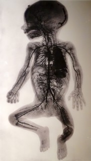 X-Ray depicting the injected arterial vessel system of a nine-month-old foetus 1908