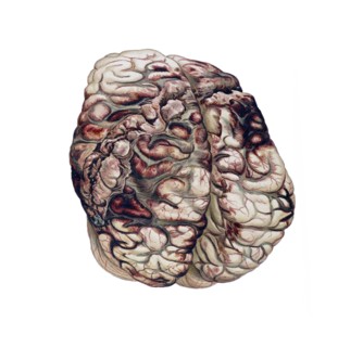 Colour illustration of a gunshot-wound in the brain