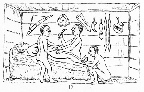Line drawing of a Cesarean