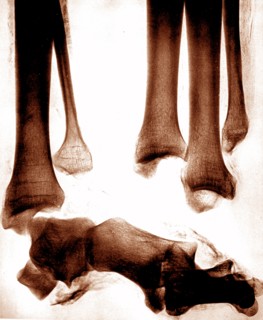 X-ray images of the legs of an ancient Egyptian mummy created soon after the announcement of Wilhelm Röntgen's discovery of X-rays