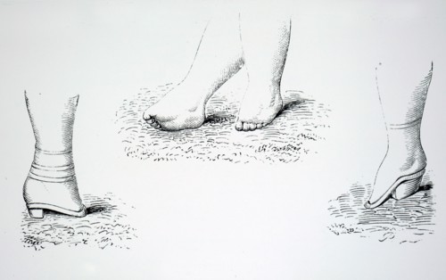 Damaged feet caused by foot binding in China