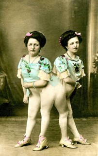 The Siamese twins Josefa and Rosa Blazek