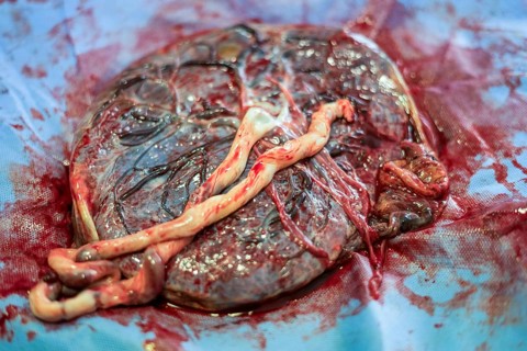 Placenta outside uterus just after childbirth in the hospital