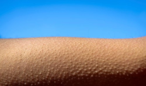 Goose bumps