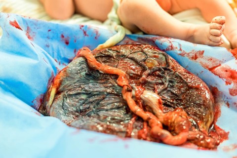 Placenta outside uterus just after childbirth and the baby in the background