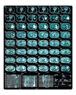 MRI scan