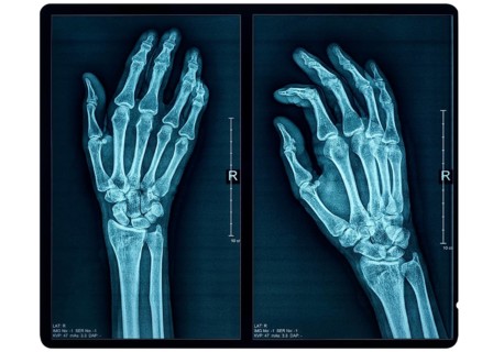 Hand X-ray of an adult female