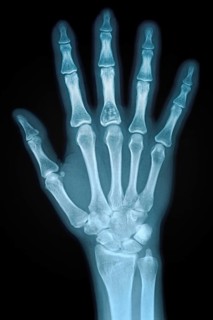 Hand X-ray of an adult female