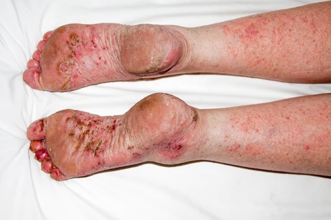 Patient with Atopic dermatitis or endogenous eczema