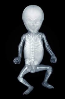 X-ray of a baby