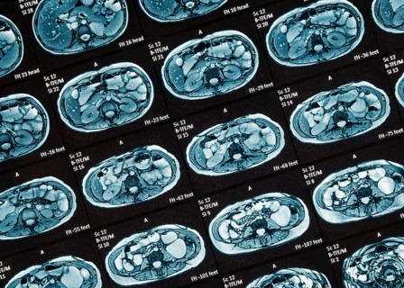 MRI scan