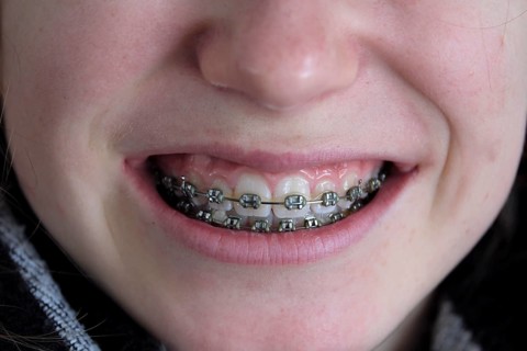 Fixed Braces