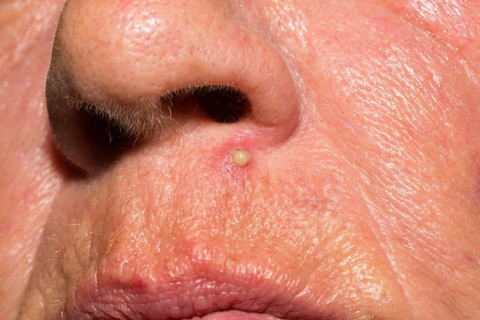 Inflamed pore below the nose of a woman