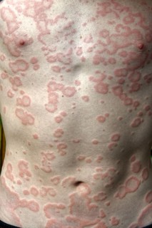 Rash