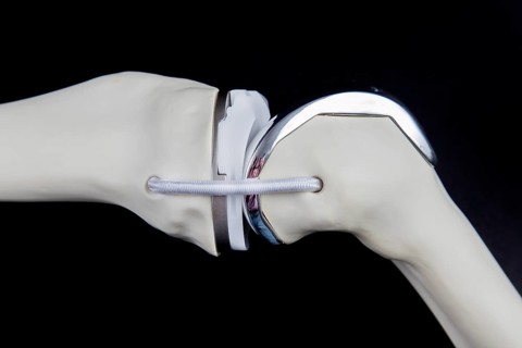 Knee prosthesis