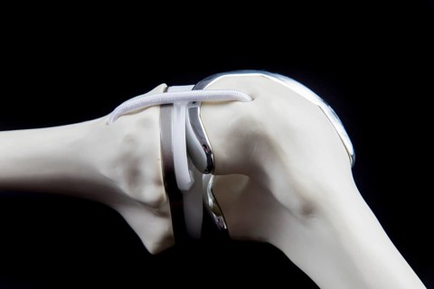 Knee prosthesis