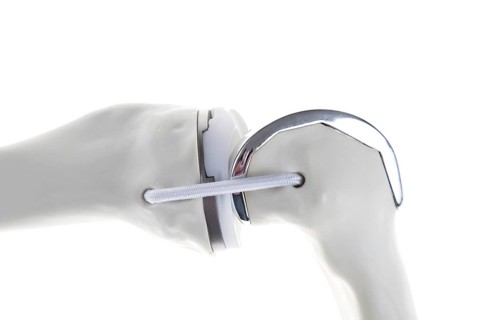 Knee prosthesis