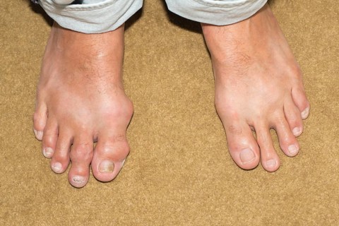 Male foot with gout