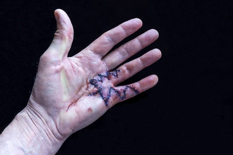 Fresh surgical sutures of a Duypuytren's contracture on the small and ring finger of the left hand