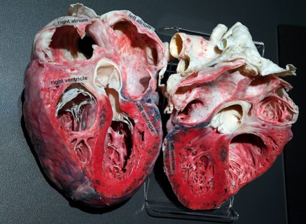 Plastinate