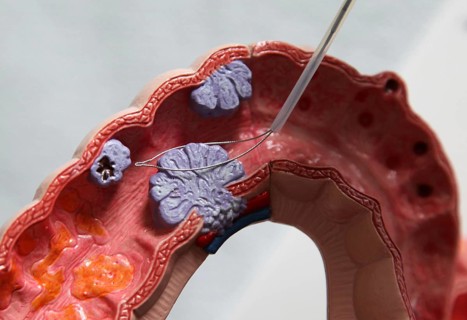 Colonoscopy