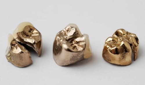 Dental gold