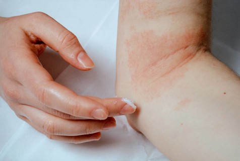 Woman applying ointment to eczema at the elbow