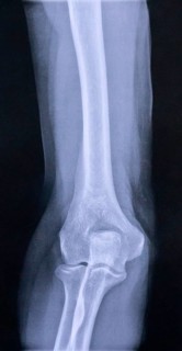 X-ray image of elbow and upper arm