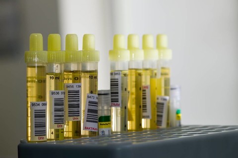Capillary tubes filled with yellow urine