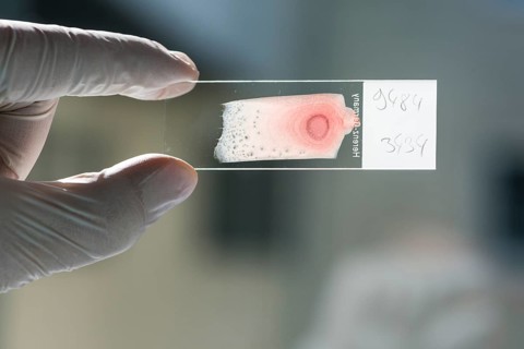 Blood smeared on a glass slide for diagnosis