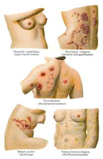 Skin diseases
