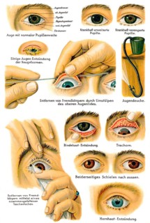 Various eye diseases