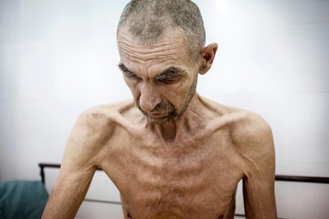Tuberculosis and HIV in Moldova