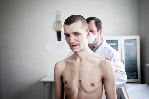 Tuberculosis and HIV in Moldova