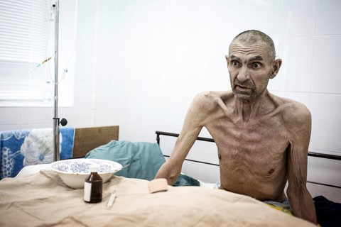 Tuberculosis and HIV in Moldova