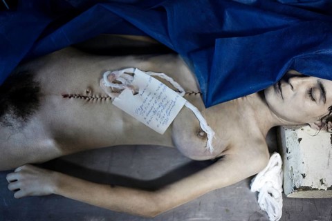 Tuberculosis and HIV in Moldova