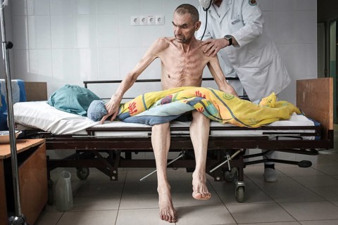 Tuberculosis and HIV in Moldova