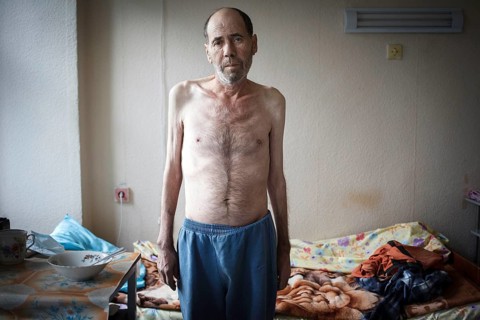 Tuberculosis and HIV in Moldova