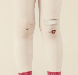 Child's legs with bruises and band-aid