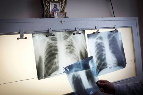Tuberculosis and HIV in Moldova
