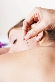 Young woman receiving acupuncture treatment on her back