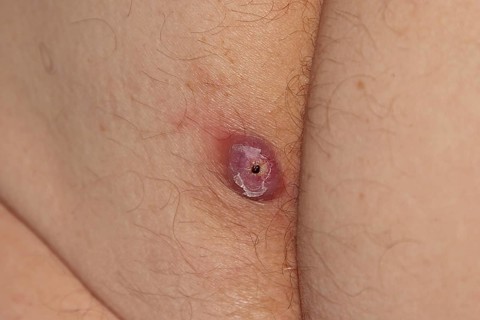 Advanced boil or furuncle on a person's left buttock