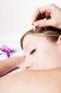 Young woman receiving acupuncture treatment on her head
