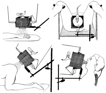 Irradiation of the hand