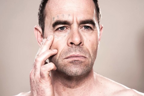 Man with markings for plastic surgery on his face
