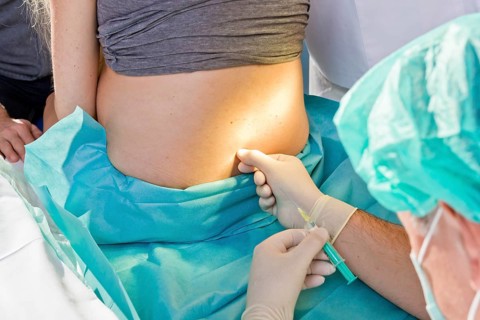 Pregnant women during delivery in the delivery room with an anesthesiologist applying a PDA or epidural